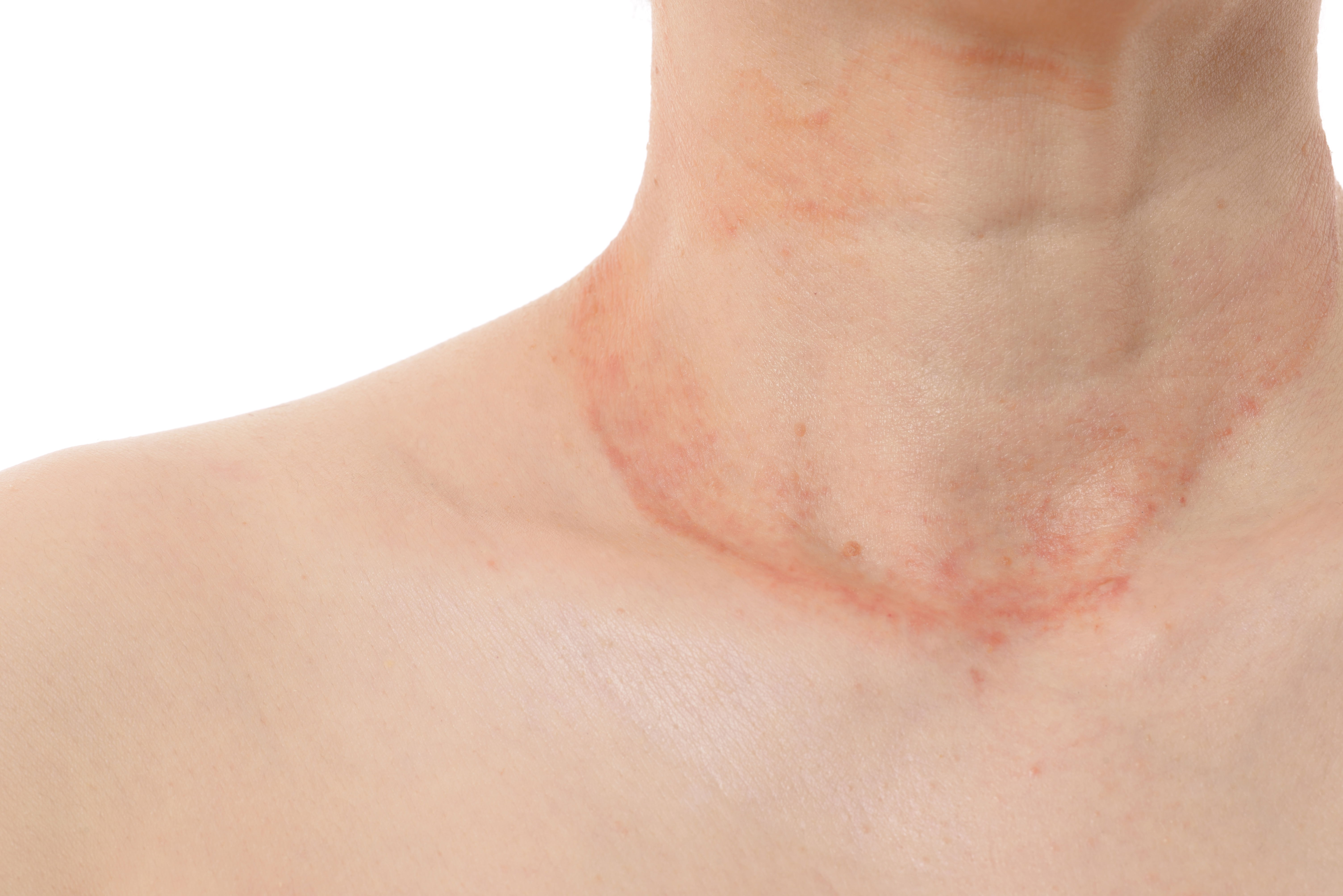 Deutlich sichtbare Symptome und Kratzspuren am Hals
