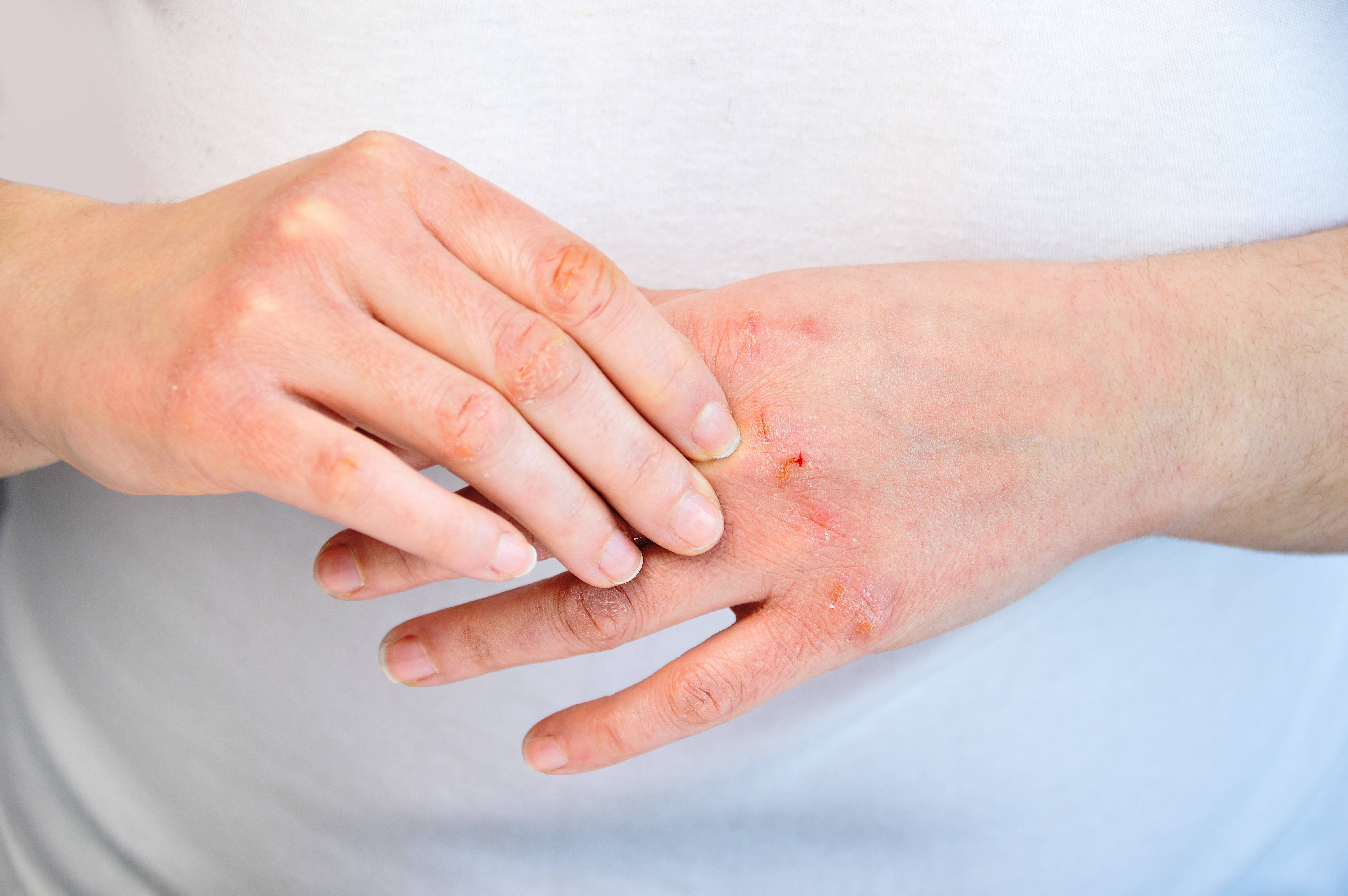 Nahaufnahme von einer Hand, welche die andere Hand kratzt, da diese von Neurodermitis Symptomen betroffen ist.