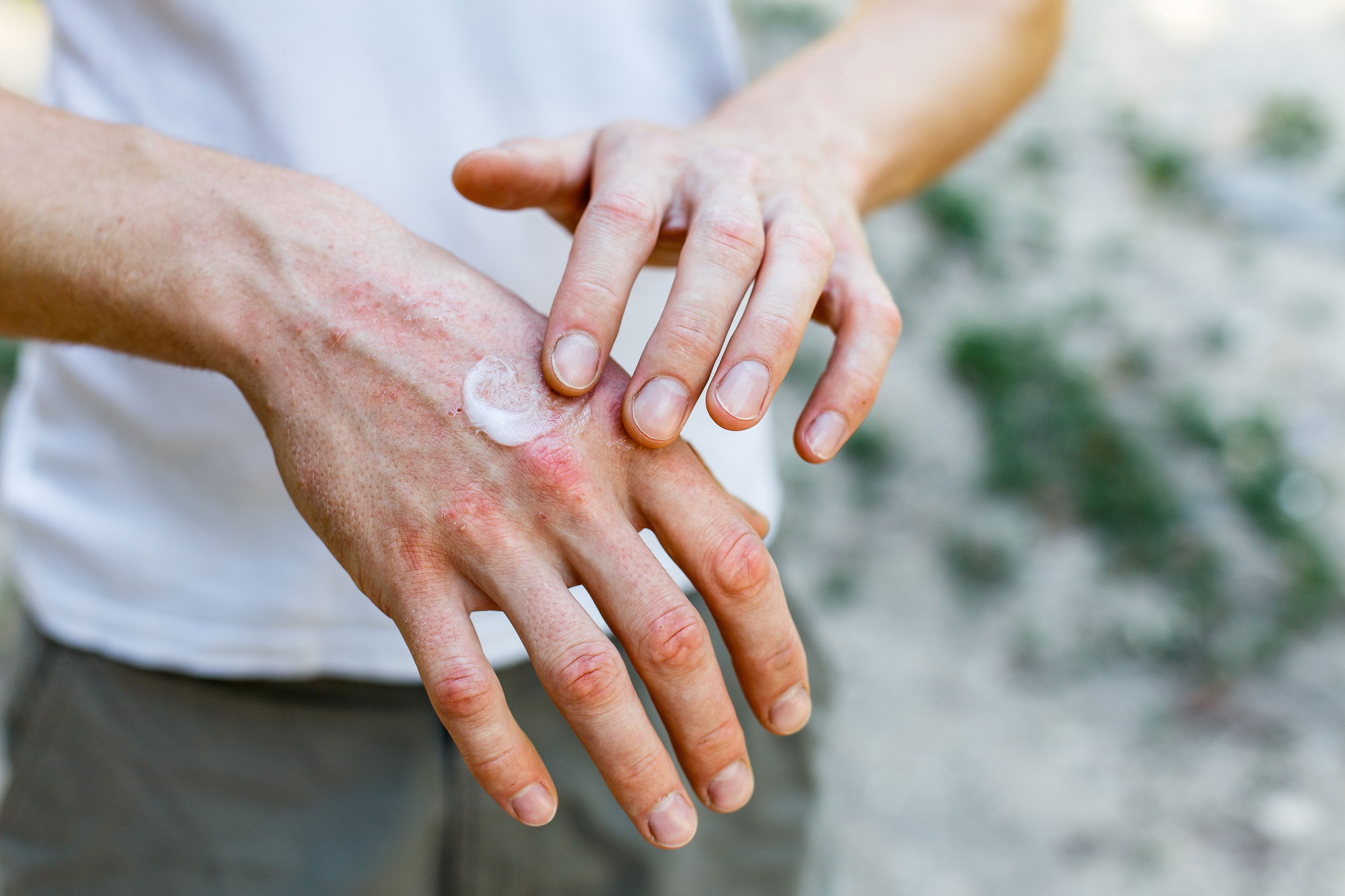 Nahaufnahme der Hände einer Frau, während sie sich diese eincremt, da sie von Neurodermitis Symptomen wie roten Kratzspuren und Austrocknung betroffen sind.