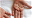 Bild zeigt Handflächen, die von Symptomen einer Neurodermitis befallen sind.