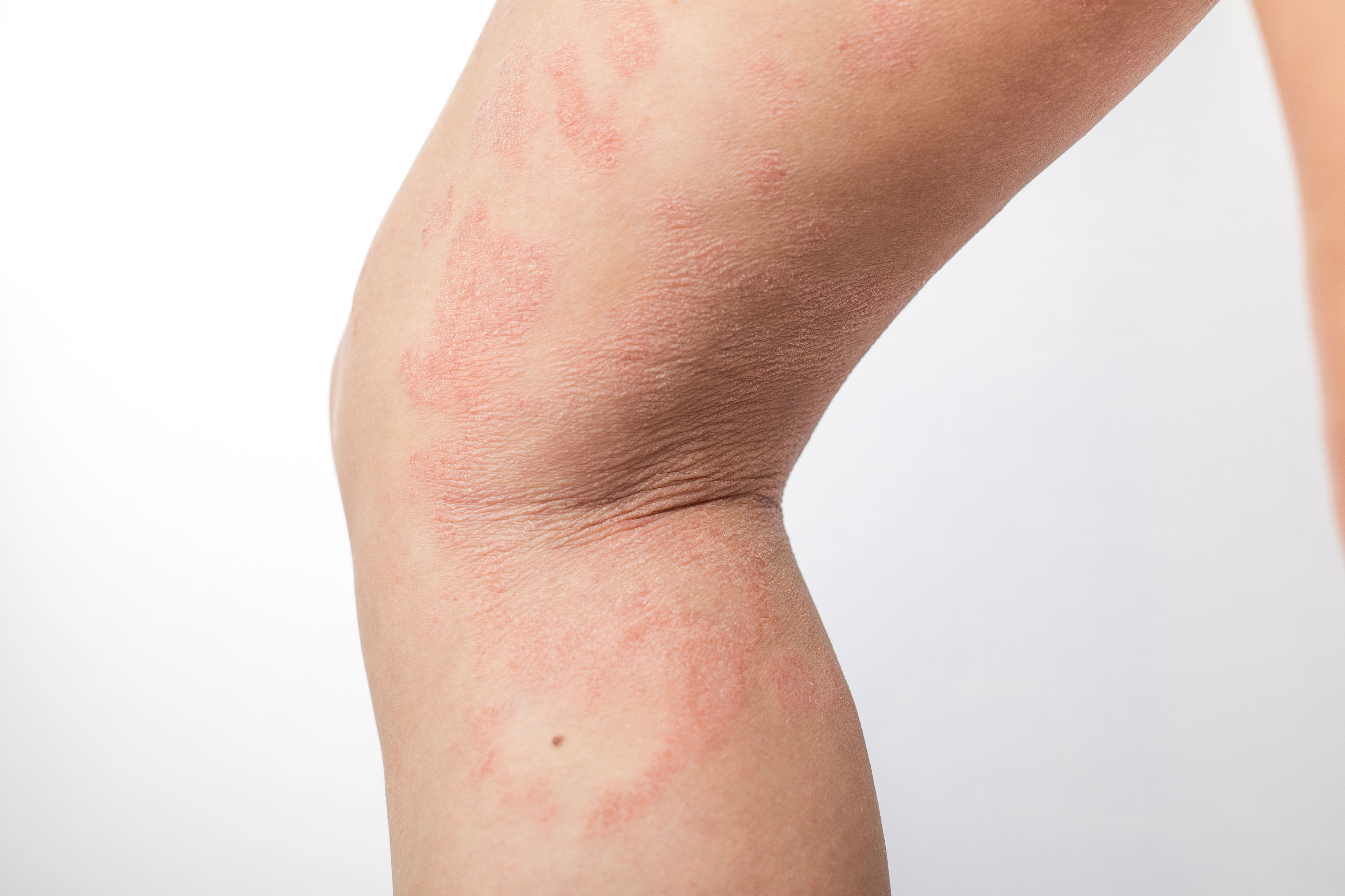 Eine Kniekehle mit geschwollener und geröteter Haut als Anzeichen einer Neurodermitis an den Beinen.