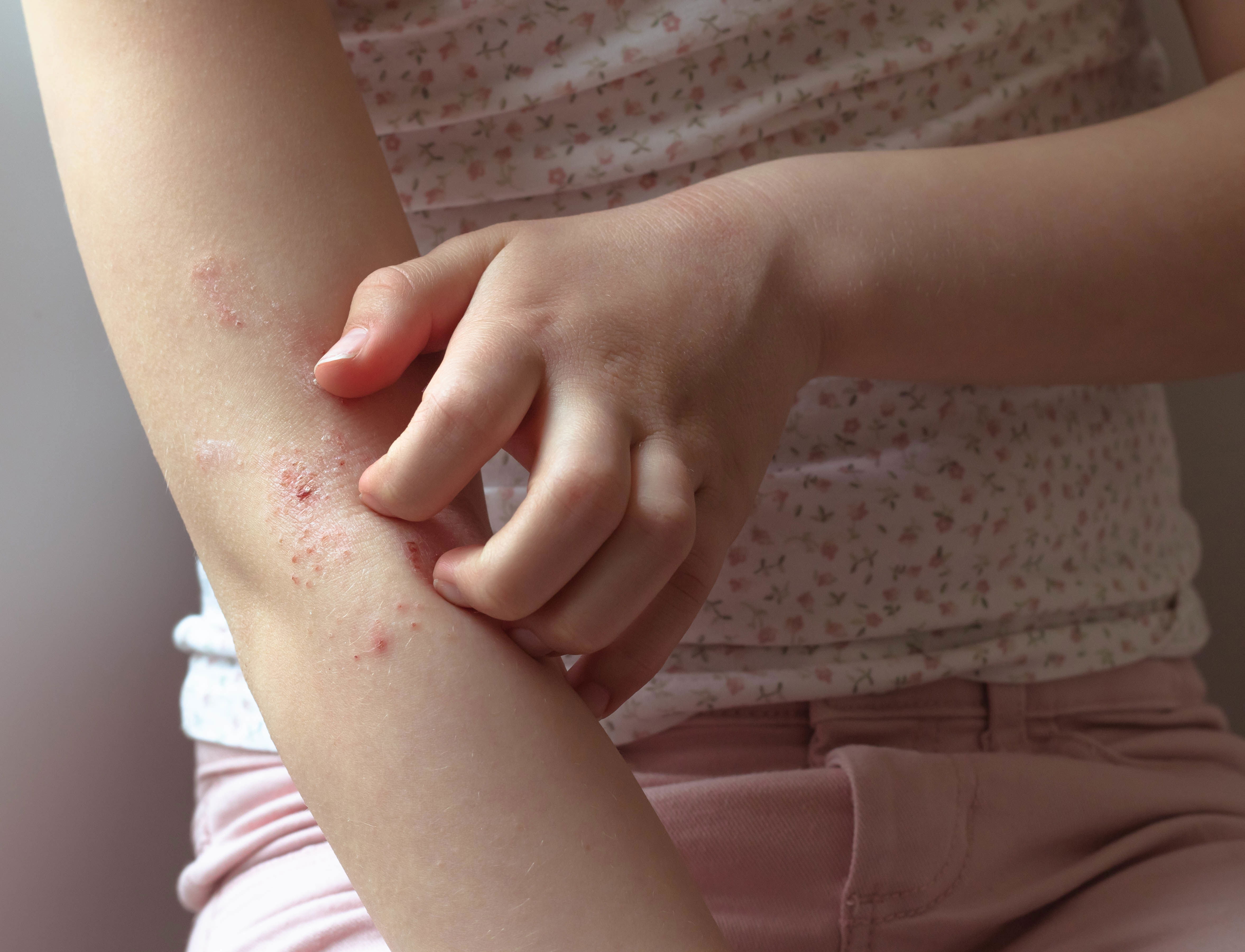 Foto eines jungen Mädchens, welches sich an den Armen kratzt, die deutlich von Hautverdickungen, Ekzemen und Rötungen gezeichnet sind
