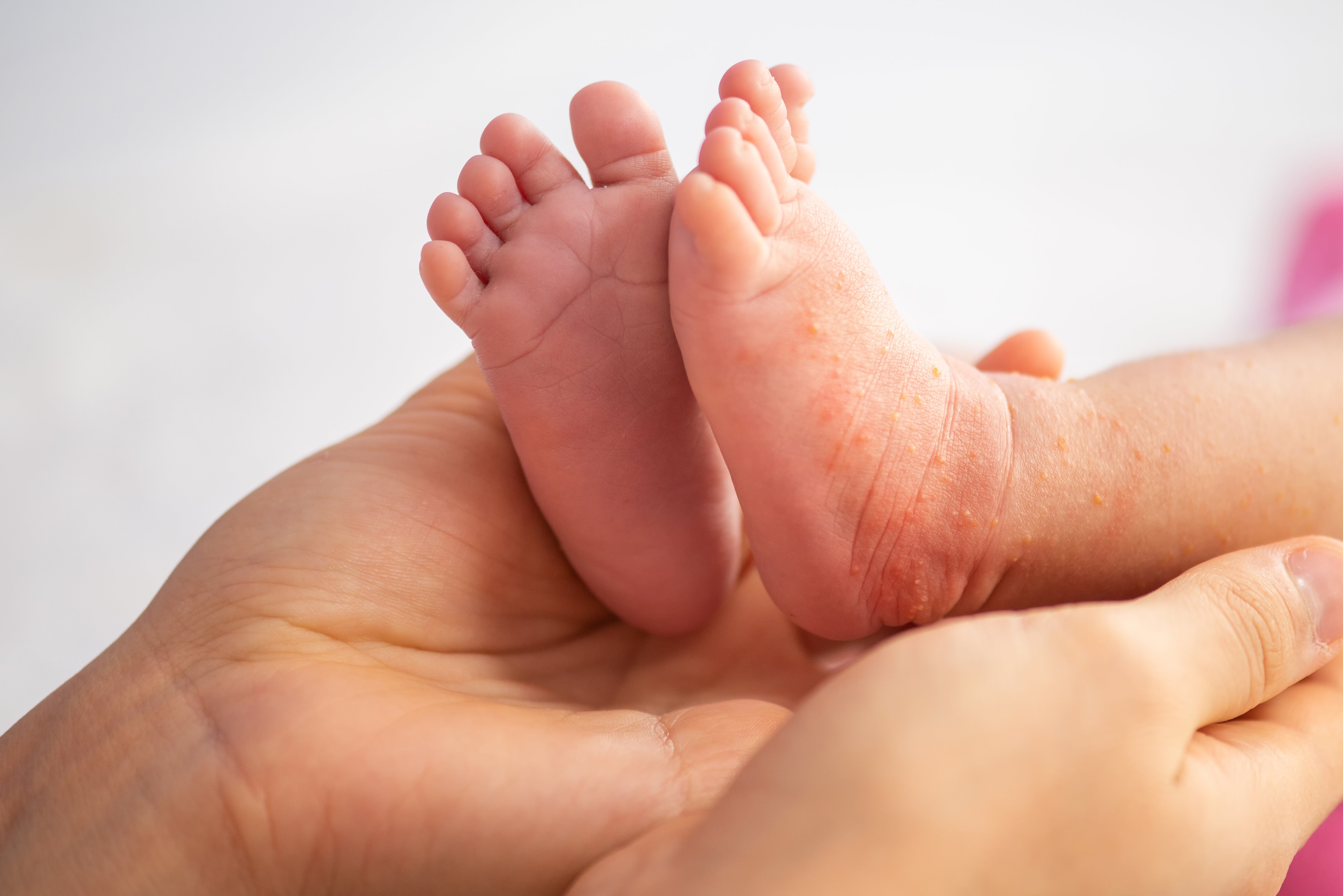 Babyfüße mit Neurodermitis werden von einem Erwachsenen behutsam in den Händen gehalten