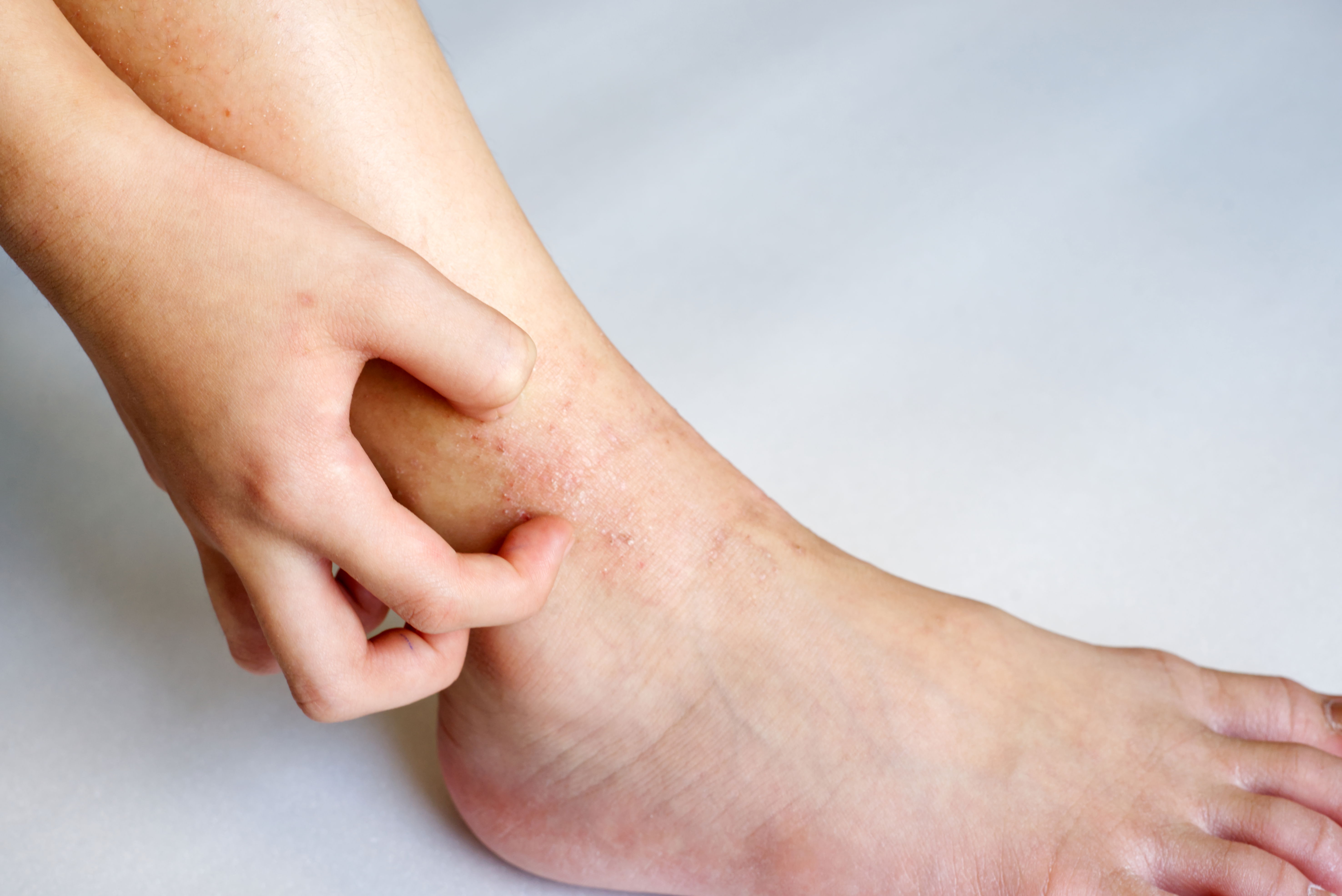 Bild einer Hand, die das Fußgelenk kratzt, welches von Neurodermitis Symptomen betroffen ist.