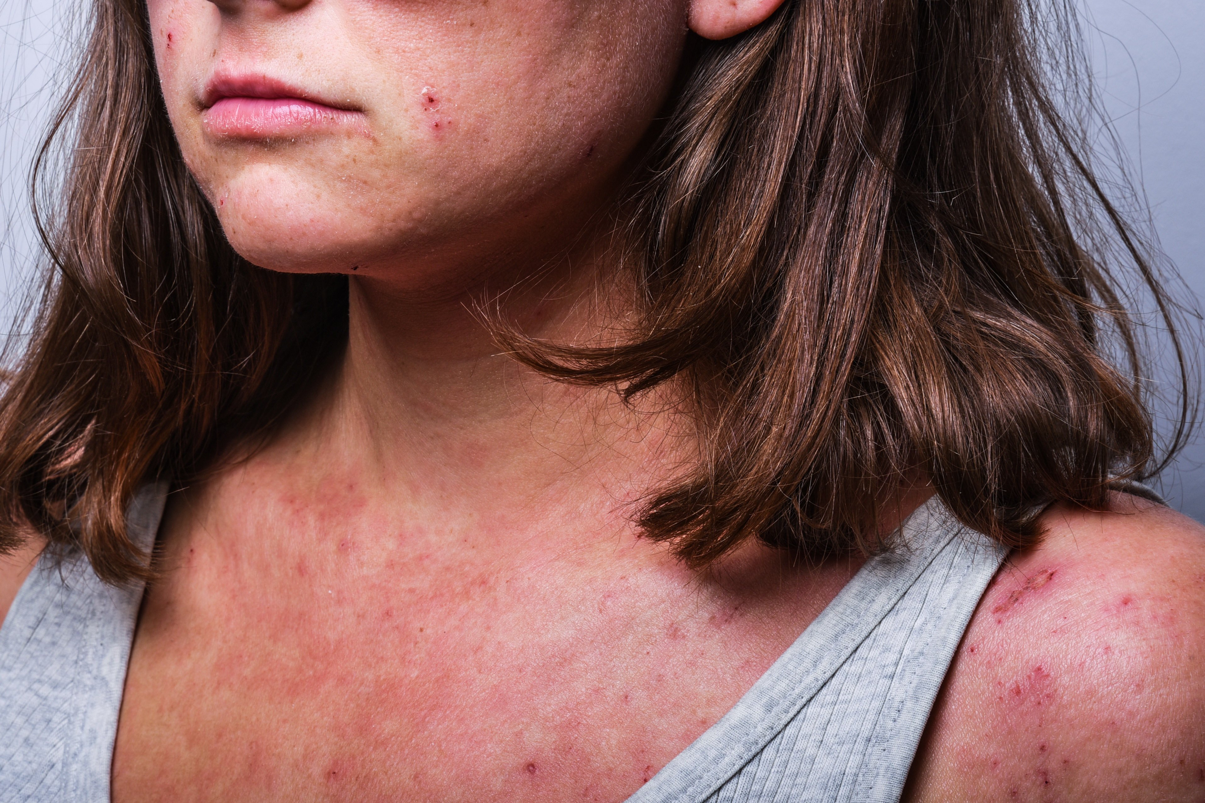 Frau mit starken Neurodermitis Symptomen wie Rötungen, Lichenifikation und Schwellungen in Gesicht und Dekoleté