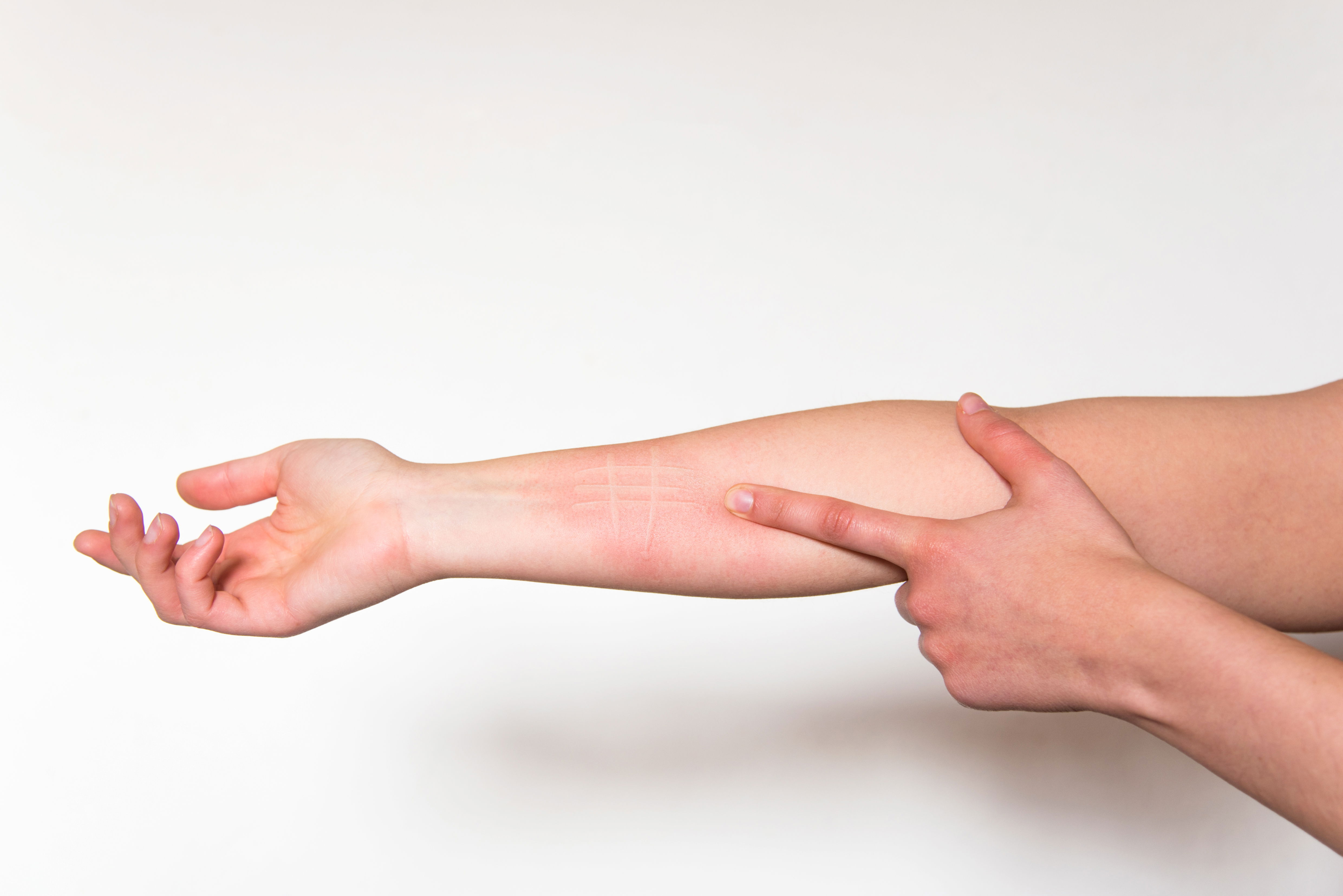 Foto eines Unterarms, der die Symptome eines weißen Dermographismus zeigt. Dabei hinterlässt das Streichen über die Haut weiße Linien, was ein Symptom für eine Atopie ist..