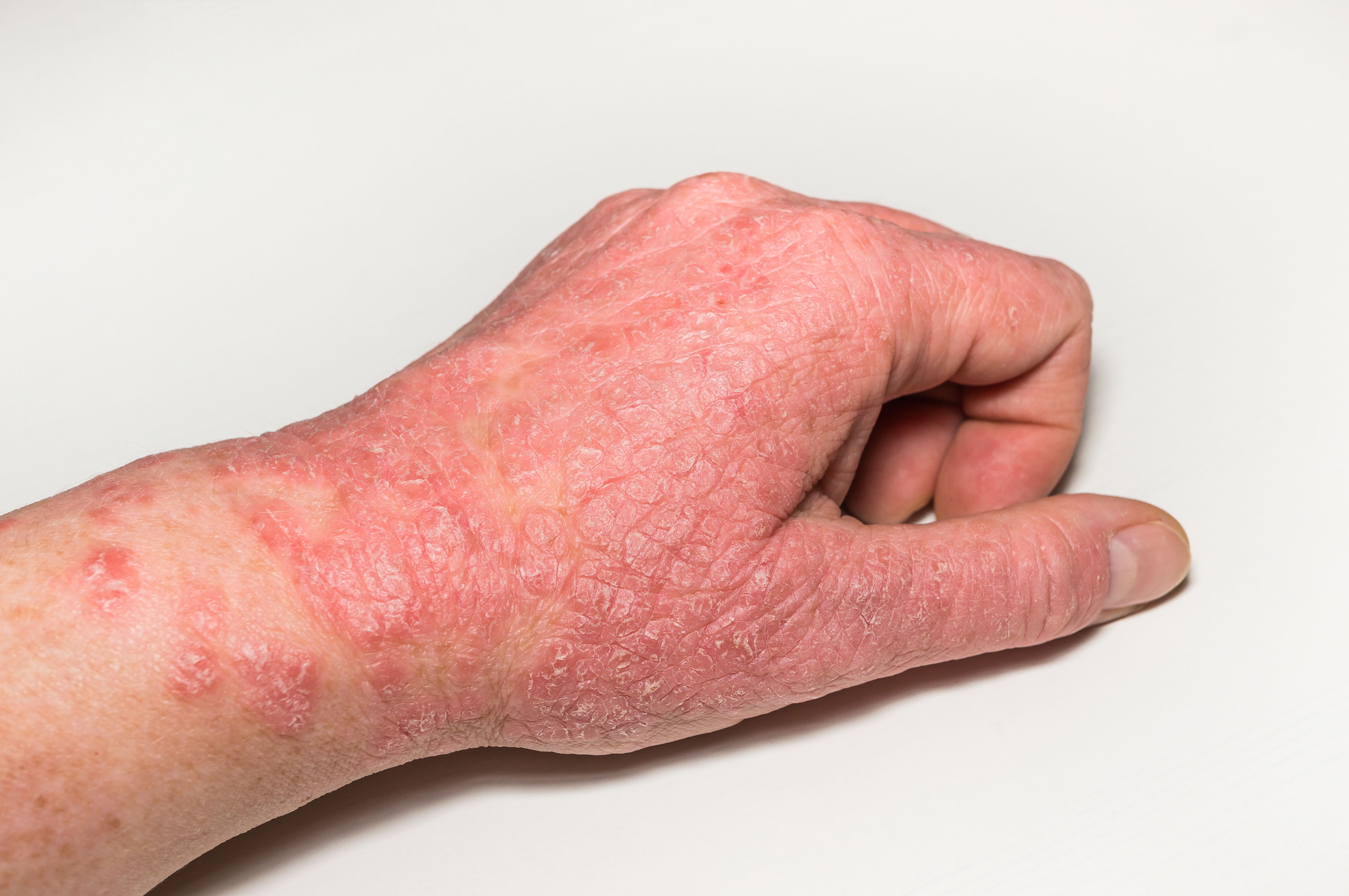 Nahaufnahme einer Hand mit Neurodermitis Symptomen wie Lichenifikation (Vergröberung der Haut), Rötungen und Ekzemen