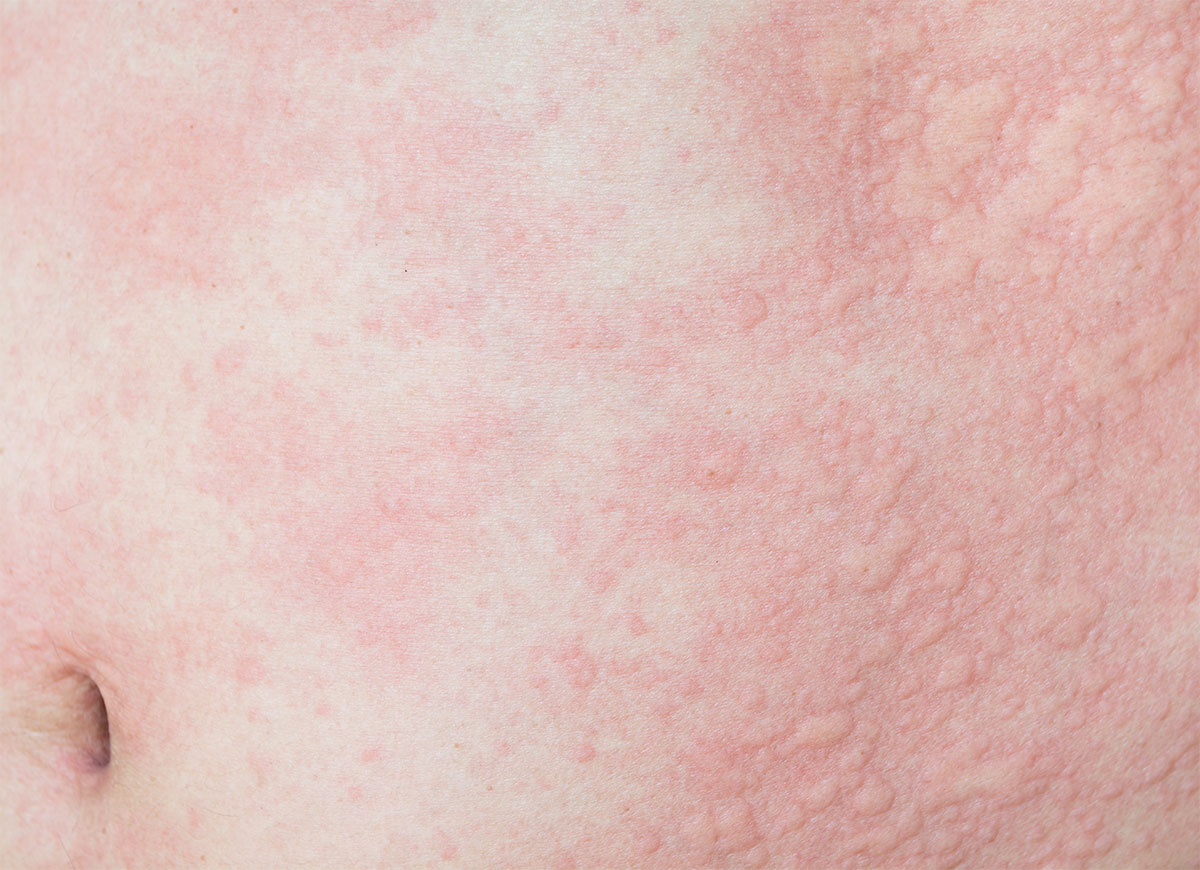 Sehr Empfindliche Haut Bei Berührung physiogel.de